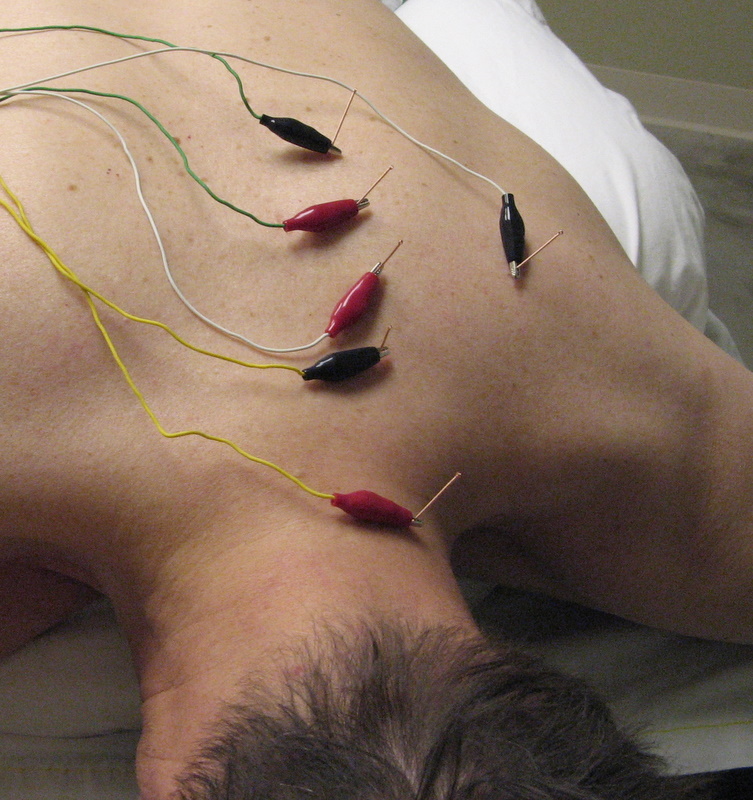 A skeptic visits a chiropractor for acupuncture treatment 3 electrified needles.jpg