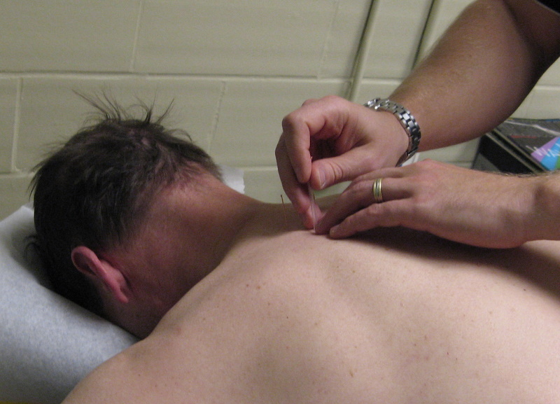 A skeptic visits a chiropractor for acupuncture treatment 1 inserting needles.jpg