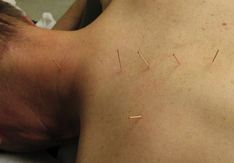 A skeptic visits a chiropractor for acupuncture treatment 2 needles inserted.jpg
